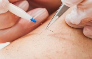 Электроэпиляция в Минске