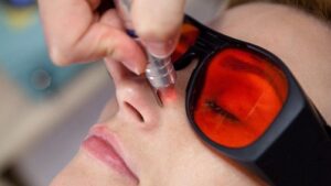 Лазерное удаление сосудов в Минске