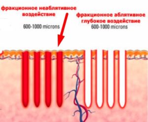 Аблятивное и неаблятивое фракционное омоложение