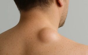 Удаление жировика в Минске